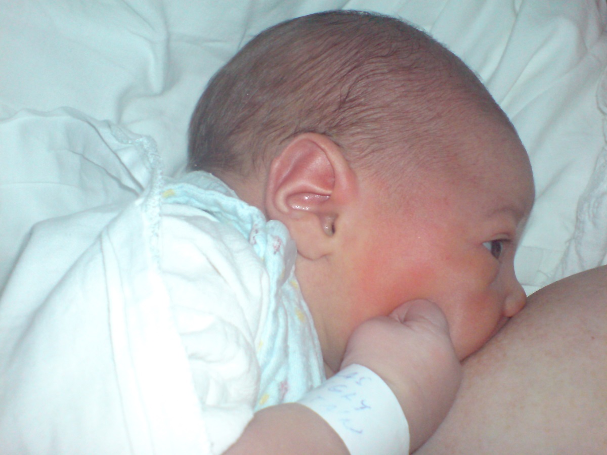 Visszér kezelése szoptató anya számára, A mellgyulladás és tejláz kialakulása, tünetei